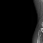 Eklem İçi Enjeksiyonlar ve Hastane Bahçesindeki Çantacılar