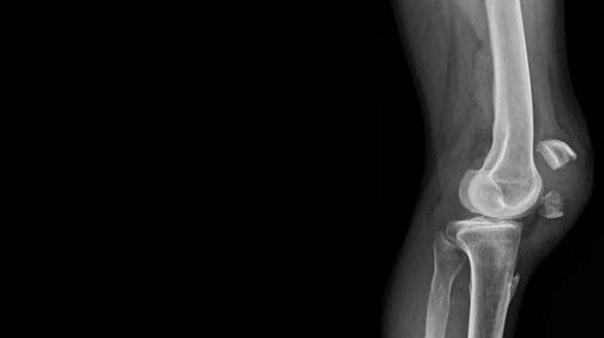 Eklem İçi Enjeksiyonlar ve Hastane Bahçesindeki Çantacılar