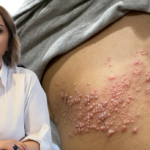 Prof. Dr. Esin Davutoğlu Şenol İle Zona Hastalığı ve Aşısı